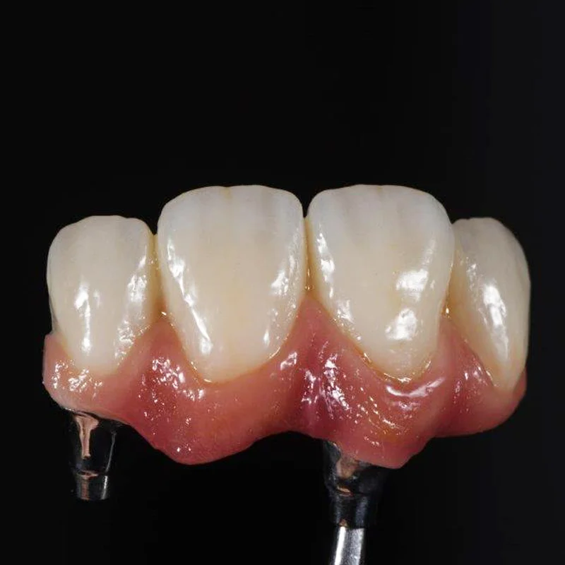 World class dental restoration